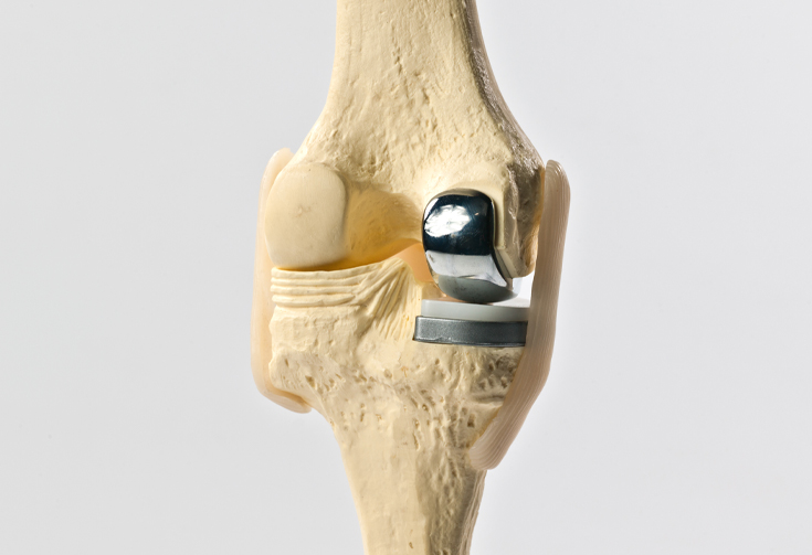 Photo: CEMENTLESS PARTIAL KNEE REPLACEMENT